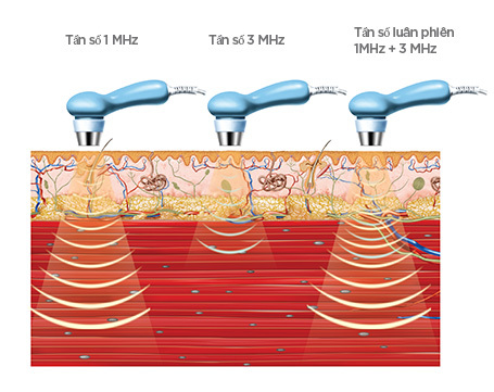 Hiệu ứng xuyên sâu tổ chức của chùm tần số siêu âm